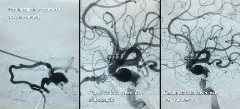 Angiografia cerebral