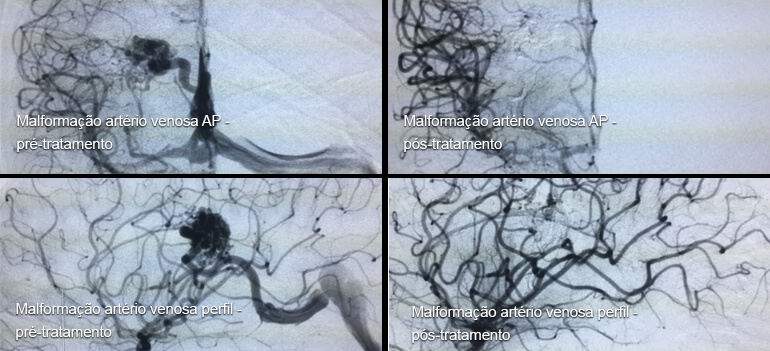 Angiografia cerebral