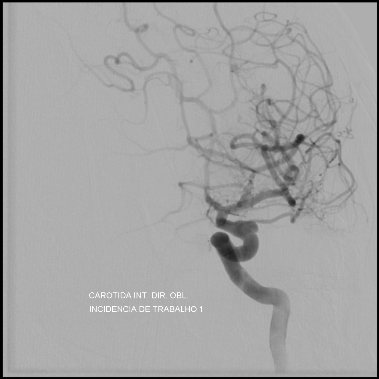 Tratamento endovascular de aneurismas de segmento oftálmico com colo desfavorável