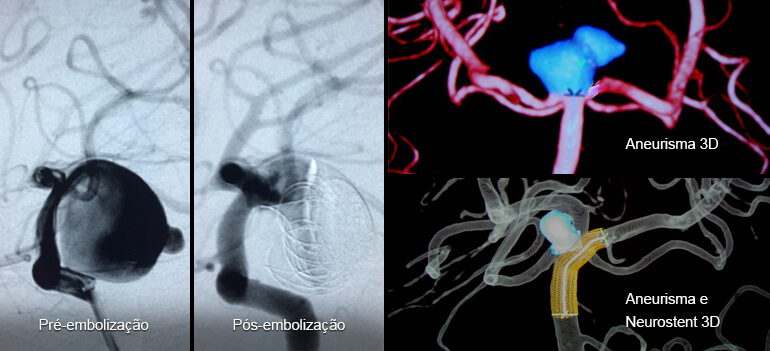 Angiografia cerebral